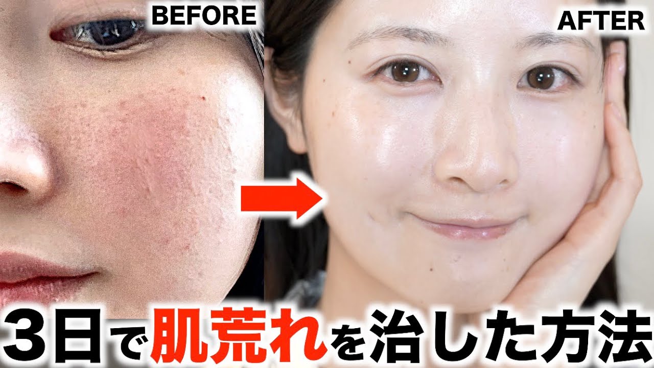 肌荒れが酷かった私が3日間で治したスキンケア全部見せます【鎮静スキンケアルーティン】(敏感肌/乾燥肌/肌荒れ/花粉)
